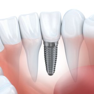 Dental implants