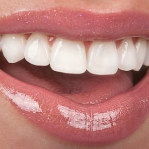 Porcelain Veneers 