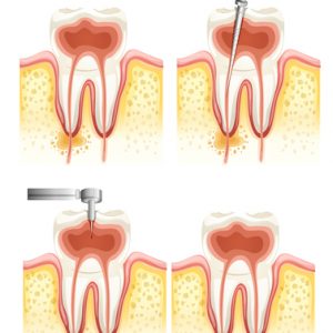 Root Canal Therapy