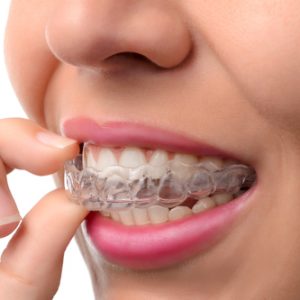 Invisalign Dentist