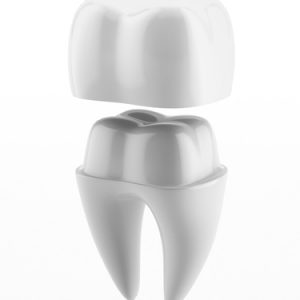 Porcelain Crowns