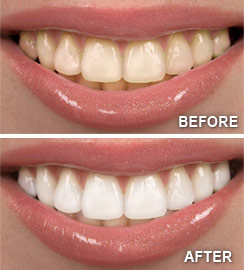 Teeth Whitening