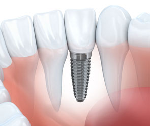 Rye Dentist- Dental Implants