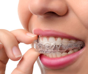 Rye Dentist Invisalign braces