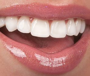 Rye Dentist Porcelain Veneers